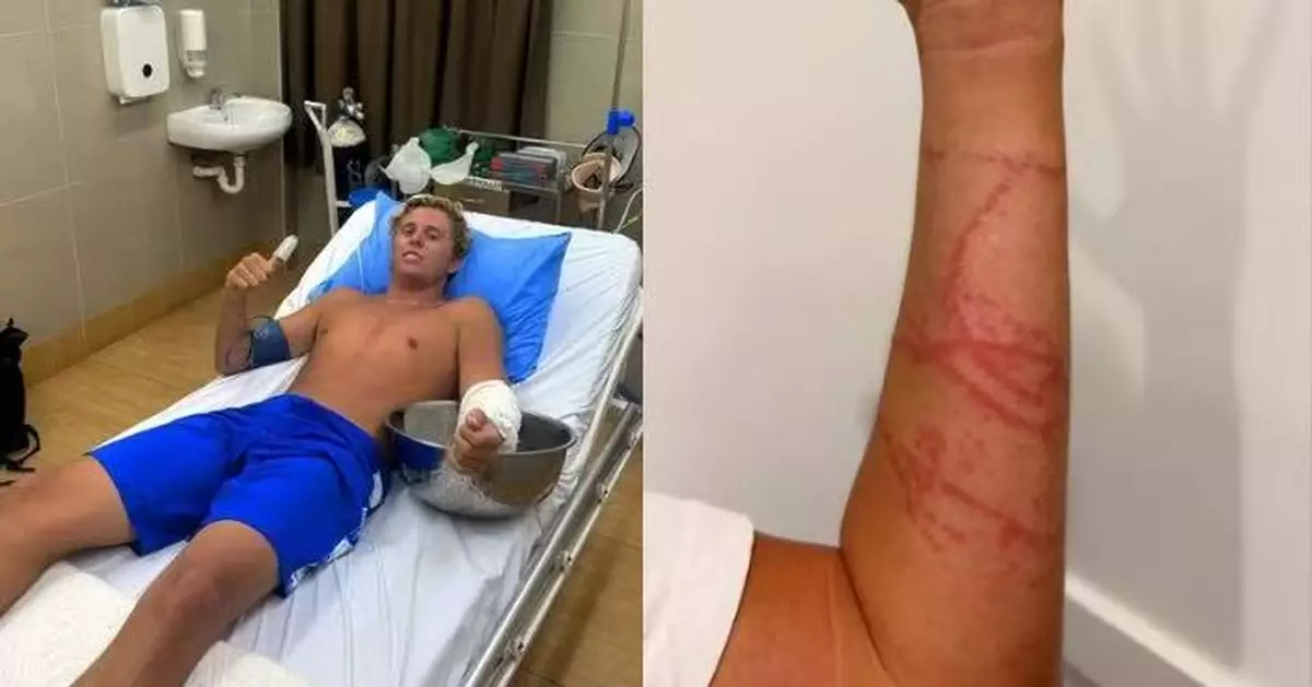 5分鐘內可奪命！澳男斐濟衝浪遭劇毒水母螫傷 手臂劇痛抽搐奇蹟倖存