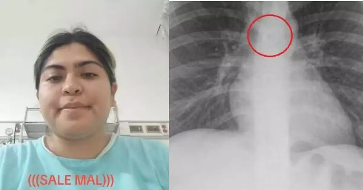 咳嗽1個月未見好轉 墨西哥女求醫揭鼻環誤入肺部距主動脈僅0.5毫米