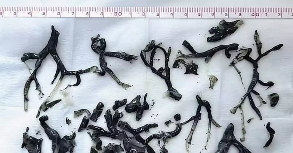 吸入大火濃煙後呼吸困難 8旬翁求醫驚揭肺部長滿「樹枝狀黑物」確診罕見疾病