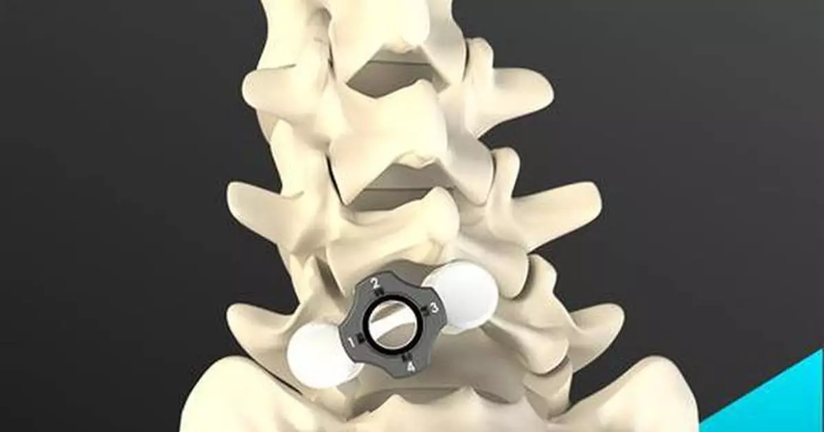 艾利維安醫療「慧視」獲FDA批准 創新即棄系統簡化脊椎減壓