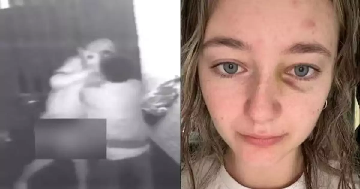 夜店外拒絕男子搭訕 英女遭對方重拳打斷鼻樑昏迷5分鐘留心理陰影