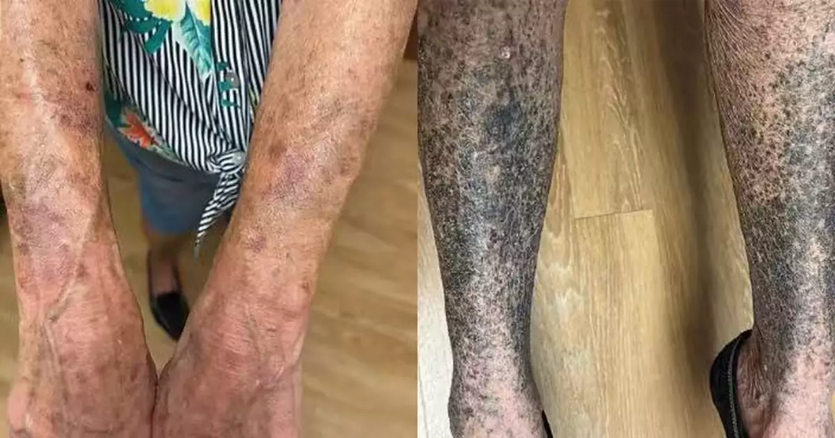 患皮膚炎求醫獲醫生開常見抗生素 美婦服用2周後「皮膚變藍灰色」