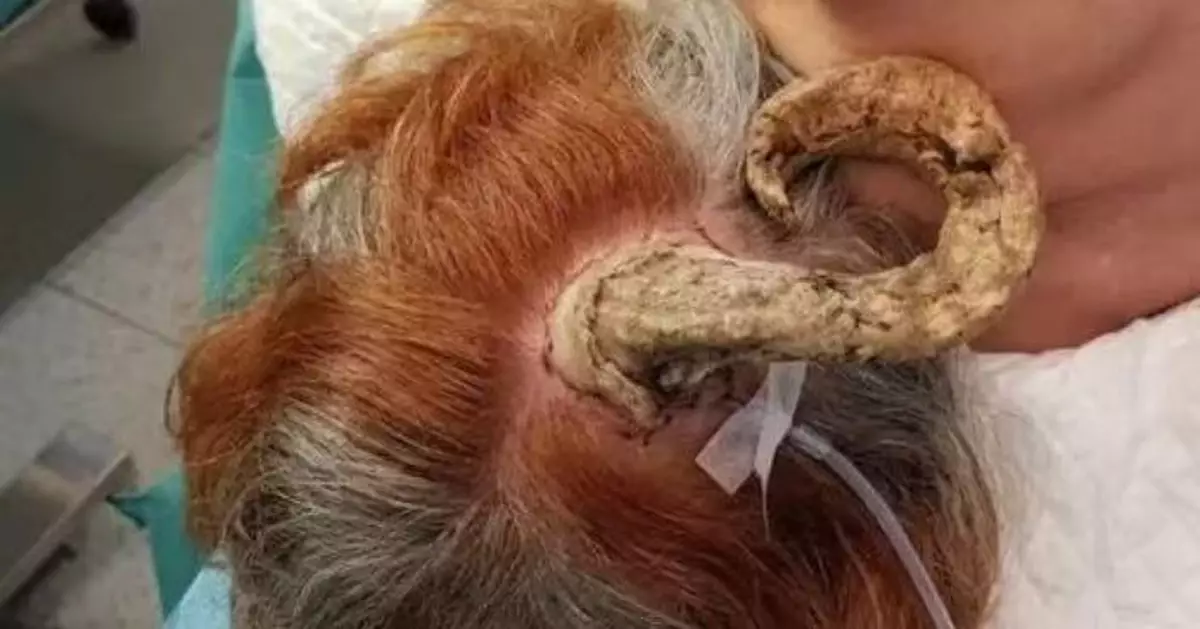 國外婦後腦長26cm腫塊如「獸角」！親友疑邪靈附身　求醫揭惡性皮膚癌