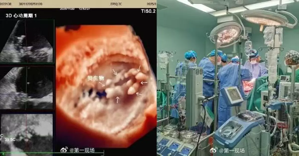 內地男反覆低燒3個月查不出病因 照超聲波揭心臟長「馬蜂窩」贅生物