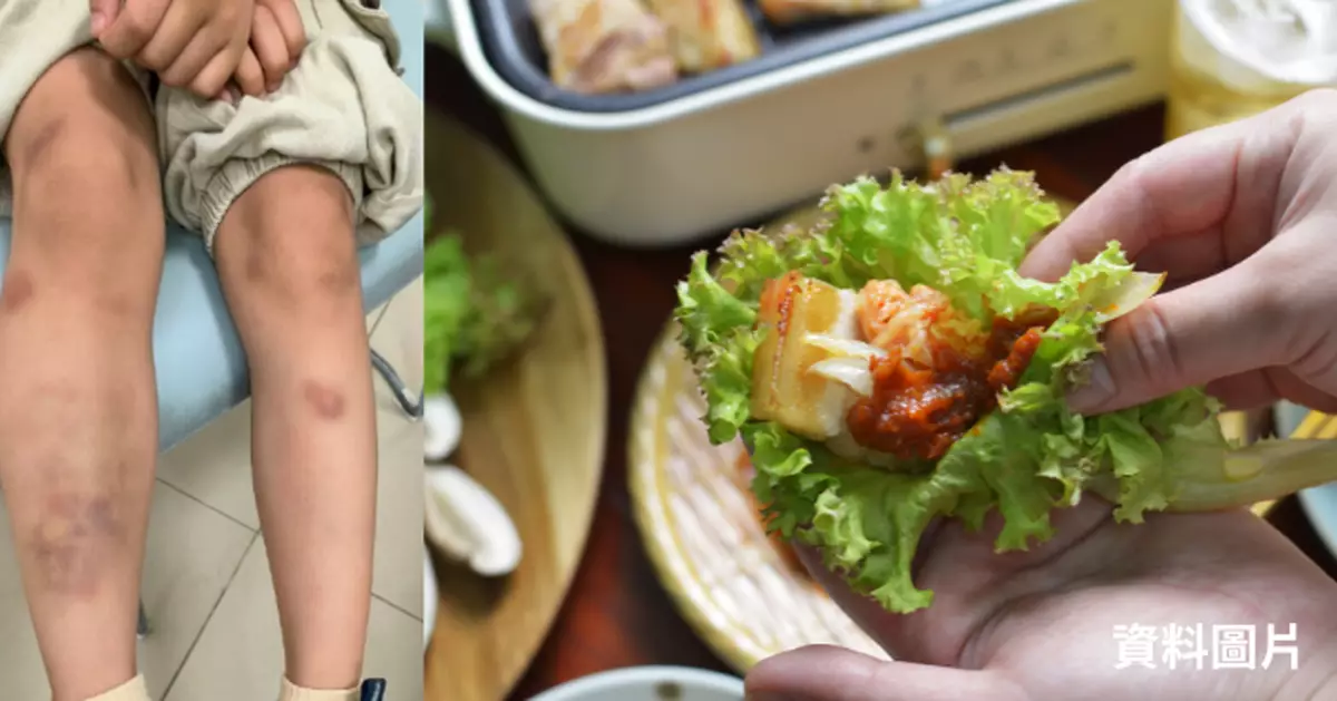 深圳6歲男童全身驚現瘀血　送院揭食「1物」染寄生蟲