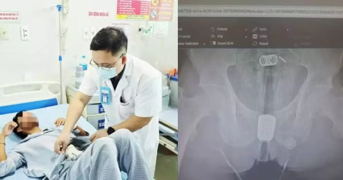 一時興起將馬桶沖洗器塞入肛門 越南漢噴頭卡直腸送院開腹2小時取出