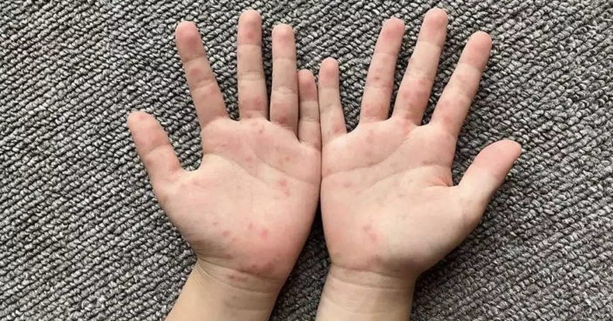 葉柏強：手足口病活躍程度升 新學年後加速在兒童之間傳播