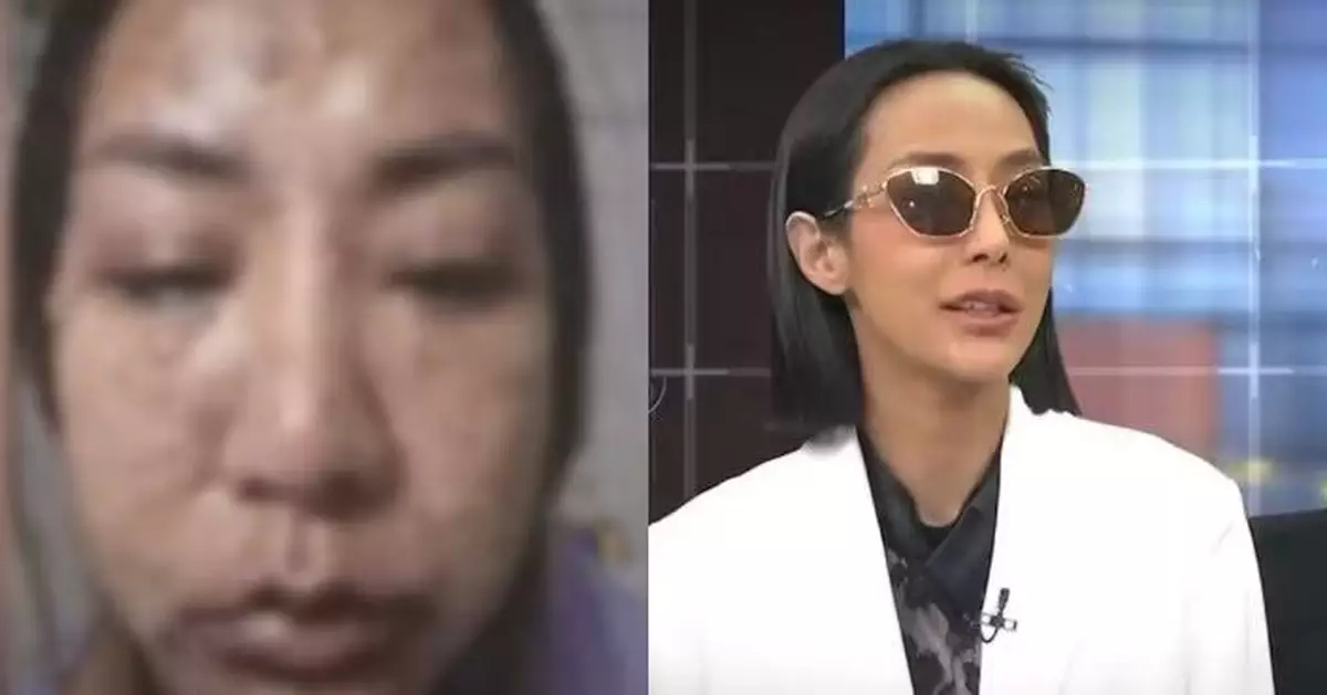 淋雨發燒求醫接受3天注射治療 泰女藥物過敏失左眼視力 動15次手術仍未恢復