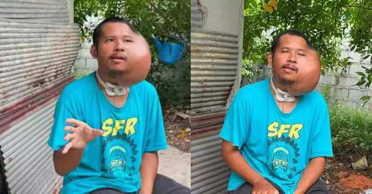 長期用牙籤剔蛀牙 泰男左臉嚴重發炎長巨大腫塊 上網求助遭質疑AI造假