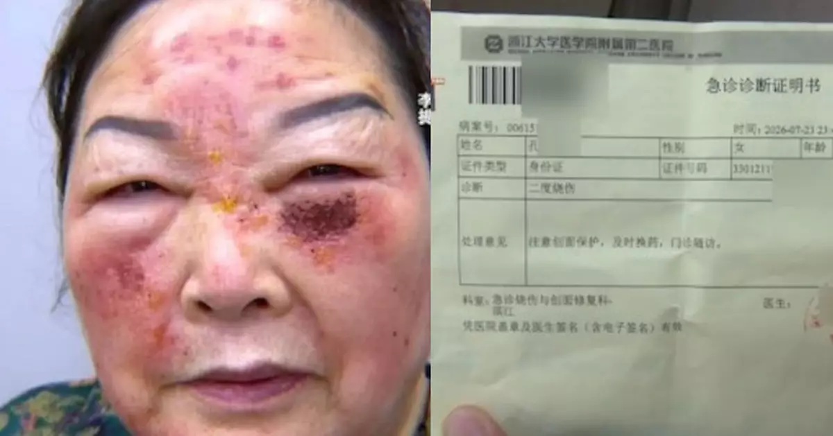 花逾2萬醫美「祛斑」 杭州7旬婦術後臉部腫痛脫皮徹夜難眠 求醫揭二度燒傷