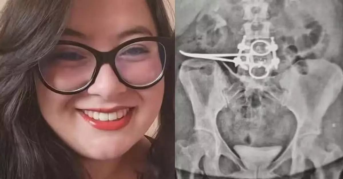切除子宮後腹痛3個月 巴西女求醫揭腹腔遺留18CM手術鉸剪致小腸壞死