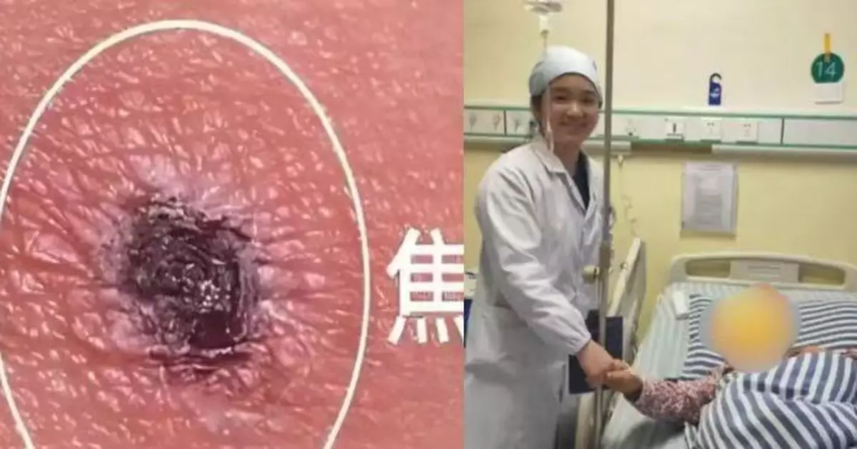 高燒一度害敗血症 湖南婦經基因測序揭感染恙蟲病 醫生：皮膚有小紅點要注意