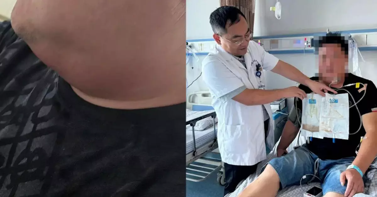 輕微牙痛拖成頸深部感染 內地貨車司機頸內積膿逾800毫升險窒息