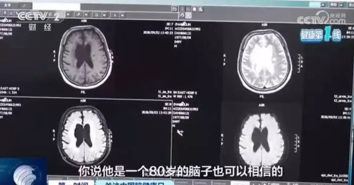 長期熬夜玩手機突右手無力 滬49歲男就醫遭揭腦萎縮「堪比80歲長者」