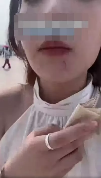 海鷗意外啄傷女子下巴，留下傷痕。網上截圖