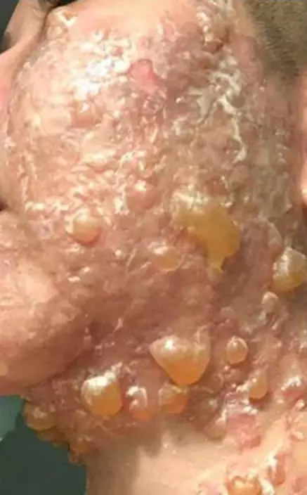 林女滿面水泡。網上圖片