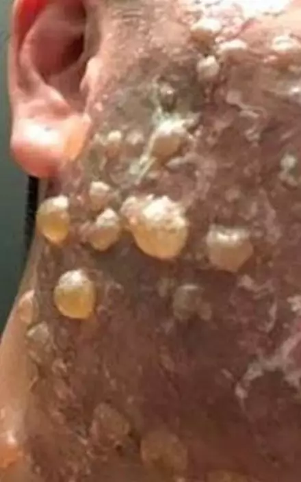 林女滿面水泡。網上圖片
