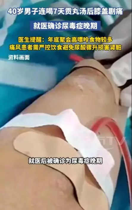 浙江一名40歲男子連喝7天貢丸湯致痛風發作，就醫確診尿毒症晚期。影片截圖