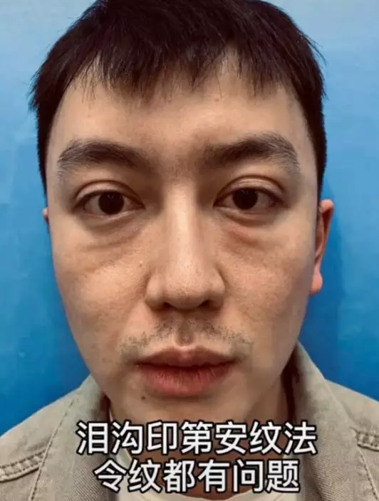 金大威到美容診所接受脂肪填充手術,沒想到竟整容失敗。網圖