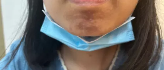 沒有開口氧化的皮下粉瘤。