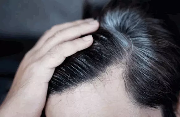 有白頭髮等於壓力大？ 1位置出現恐腸胃患病， 中醫教4招恢復黑髮。