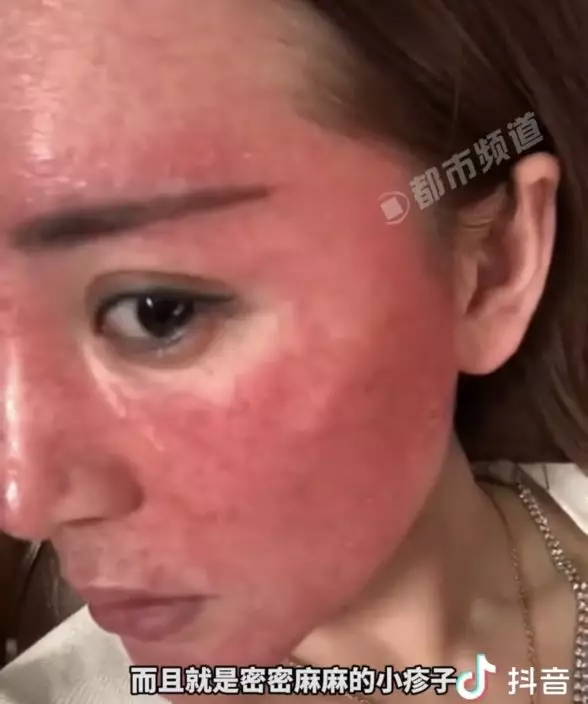 女子自曝22年冇卸妝臉部紅腫似「關公」。影片截圖