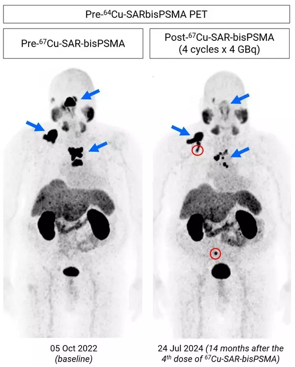 Copper-67 SAR-bisPSMA updates