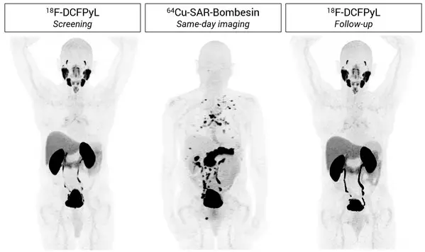 SABRE topline results: Cu-64 SAR-Bombesin is effective in detecting prostate cancer recurrence in patients with negative SOC imaging