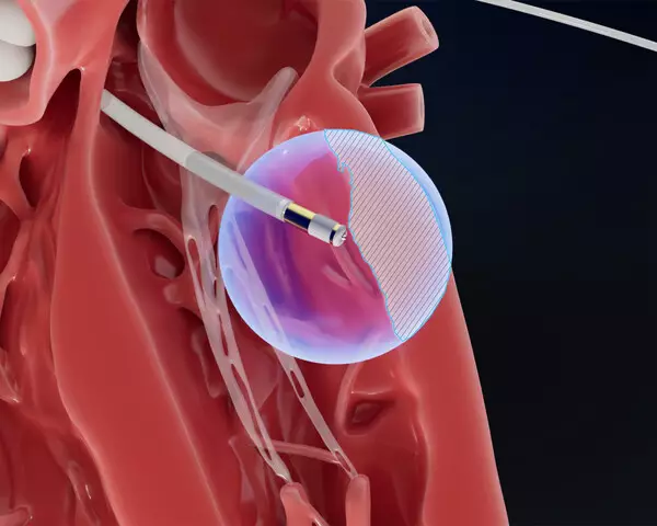 FIELD MEDICAL ANNOUNCES FIRST-IN-HUMAN DATA FOR FOCAL PFA IN SCAR-RELATED VT AT HEART RHYTHM 2025