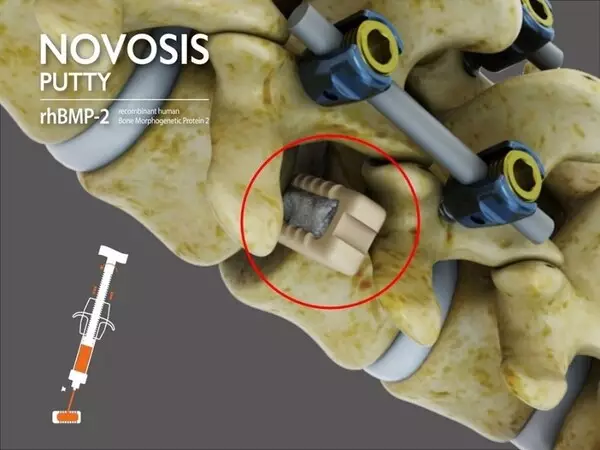 CGBIO Receives FDA IDE Approval for NOVOSIS PUTTY, Advancing Toward U.S. Market Entry
