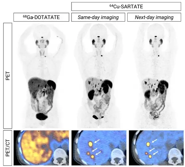 DISCO topline results: 64Cu-SARTATE is highly effective in detecting tumours in NET patients compared to SOC imaging. Phase III planning underway.