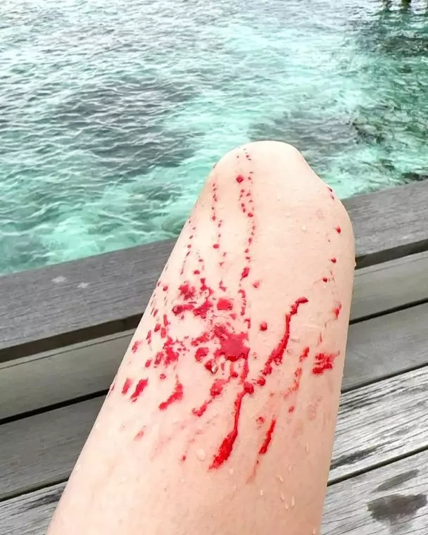 大腿被珊瑚所傷，血流不止