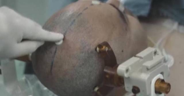 Chinese research team launches clinical trial for invasive brain ...