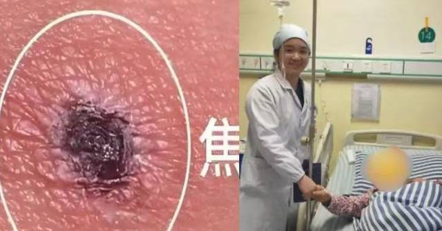 湖南婦高燒腹痛疑敗血症 基因測序揭恙蟲病 醫生警示頭頂焦痂難察