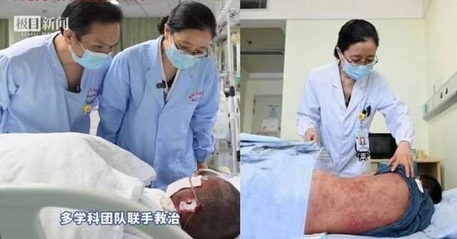 10-Year-Old Boy Suffers Severe TEN with 80% Skin Peeling After Medication Reaction