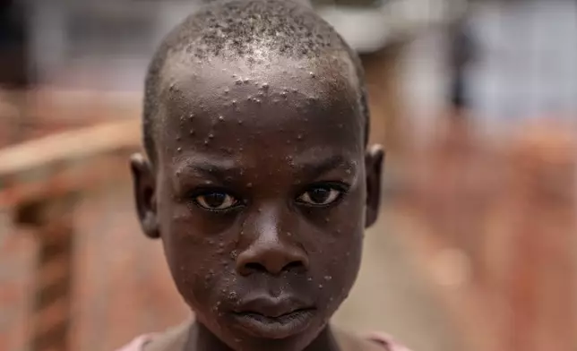 A girl suffering from mpox waits for treatment at a clinic in Munigi, eastern Congo, Monday, Aug. 19, 2024. Congo will receive the first vaccine doses to address its mpox outbreak next week from the United States, the country's health minister said Monday, days after the World Health Organization declared mpox outbreaks in Africa a global emergency. (AP Photo/Moses Sawasawa)