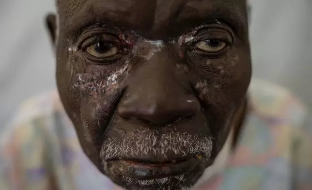 Christophe Chavilinga, 90, suffering from mpox, waits for treatment at a clinic in Munigi, eastern Congo, Friday, Aug. 16, 2024. (AP Photo/Moses Sawasawa)