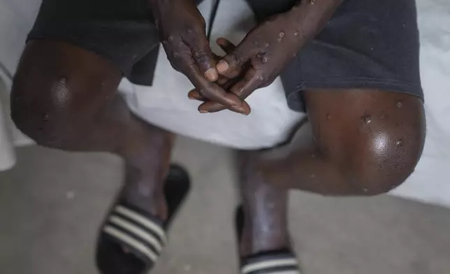 FILE - An unidentified man infected with mpox at the Goma General Hospital, Democratic Republic of the Congo, on July 16, 2024 where he continues treatment. The World Health Organization declared the mpox outbreaks in Congo and elsewhere in Africa a global emergency on Wednesday, aug. 14, 2024, with cases confirmed among children and adults in more than a dozen countries and a new form of the virus spreading. Few vaccine doses are available on the continent. (AP Photo/Moses Sawasawa)