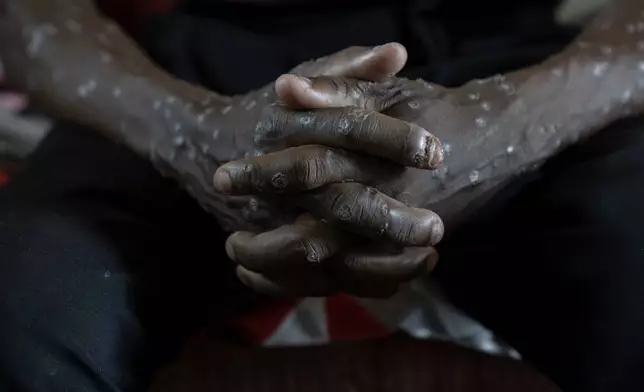 A man suffering from mpox waits for treatment at the Kamituga General Hospital in South Kivu Congo, Wednesday, Sept. 4, 2024. (AP Photo/Moses Sawasawa)