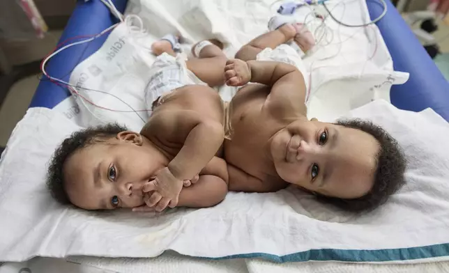 This photo provided by the Children’s Hospital of Philadelphia shows conjoined twins, Amari and Javar Ruffin, at the Children’s Hospital of Philadelphia, March 20, 2024. (Ed Cunicelli/Children’s Hospital of Philadelphia via AP)