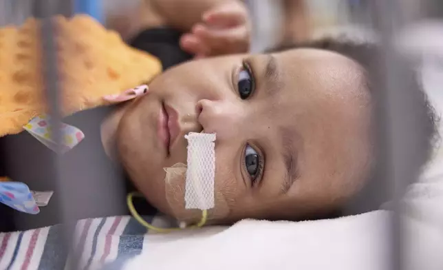 This undated photo provided by the Children’s Hospital of Philadelphia in October 2024 shows one of the previously conjoined Ruffin twins after separation surgery at the Children’s Hospital of Philadelphia. (Ed Cunicelli/Children’s Hospital of Philadelphia via AP)