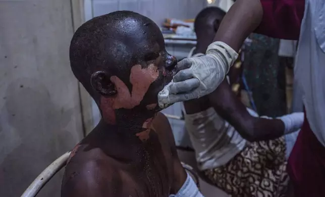 A victim of a tanker explosion from Majiya town receive treatment at the Aminu Kano teaching hospital in Kano Nigeria, Wednesday, Oct. 16, 2024. (AP Photo/Sani Maikatanga)