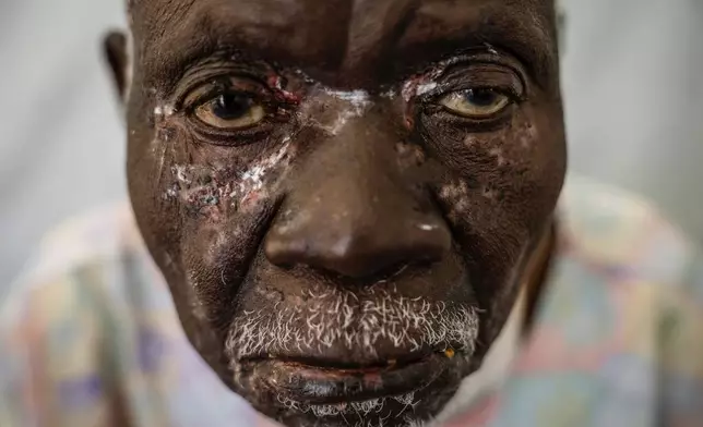 FILE - Christophe Chavilinga, 90, waits for treatment for mpox at a clinic in Munigi in eastern Congo, Aug. 16, 2024. (AP Photo/Moses Sawasawa, file)