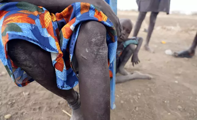 Nyingong Aguek, who contracted Guinea worm after she and her two sons drank swampy water while traveling in 2022, shows her legs where four worms had emerged from her left leg leaving scars in Jarweng, South Sudan, May 13, 2023. (AP Photo/Sam Mednick)