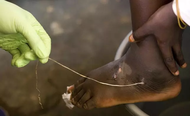 FILE - In this March 9, 2007 file photo, a guinea worm is extracted by a health worker from a child's foot at a containment center in Savelugu, Ghana. (AP Photo/Olivier Asselin, File)