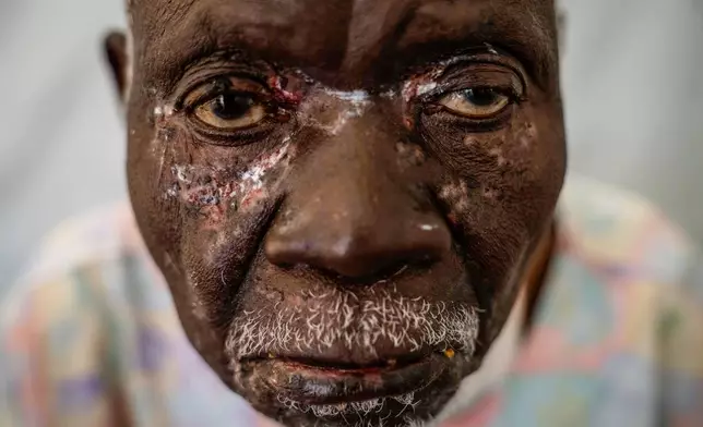 Christophe Chavilinga, 90, suffering from mpox, waits for treatment at a clinic in Munigi, eastern Congo, on Aug. 16, 2024. (AP Photo/Moses Sawasawa)