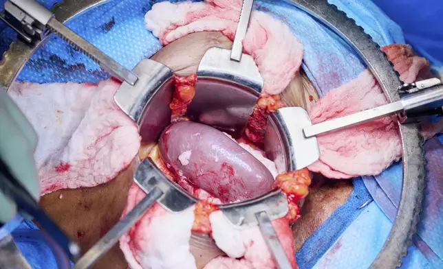 The gene-edited pig kidney moments after blood vessels are reattached and the organ is reperfused with Towana Looney’s blood at NYU Langone Health in New York City on Nov. 25, 2024. (Joe Carrotta/NYU Langone Health via AP)