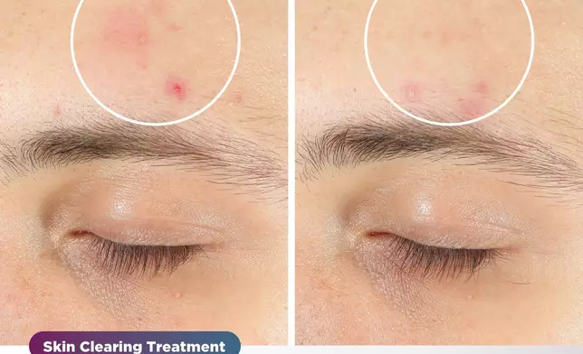 Shark™ CryoGlow™ is a MedSpa-inspired under-eye cooling + LED anti-aging &amp; acne clearing mask combining high-energy LEDs, deep-penetrating infrared, and under-eye cooling all available with the touch of a button. (Photo: Business Wire)