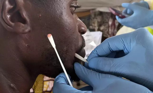 Patrick Bahati is treated for Mpox at the Miti Murhesa hospital, some 25kms from Bukavu, Democratic Republic of the Congo, Thursday, March 6, 2025. (AP Photo/Janvier Barhahiga)