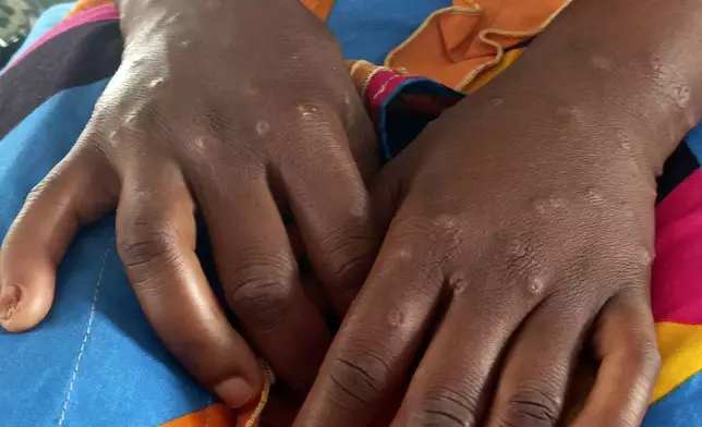 Mpox scars are seen on the hands of Bintu Biringingwa, at the Miti Murhesa hospital, some 25kms from Bukavu, Democratic Republic of the Congo, Thursday, March 6, 2025. (AP Photo/Janvier Barhahiga)